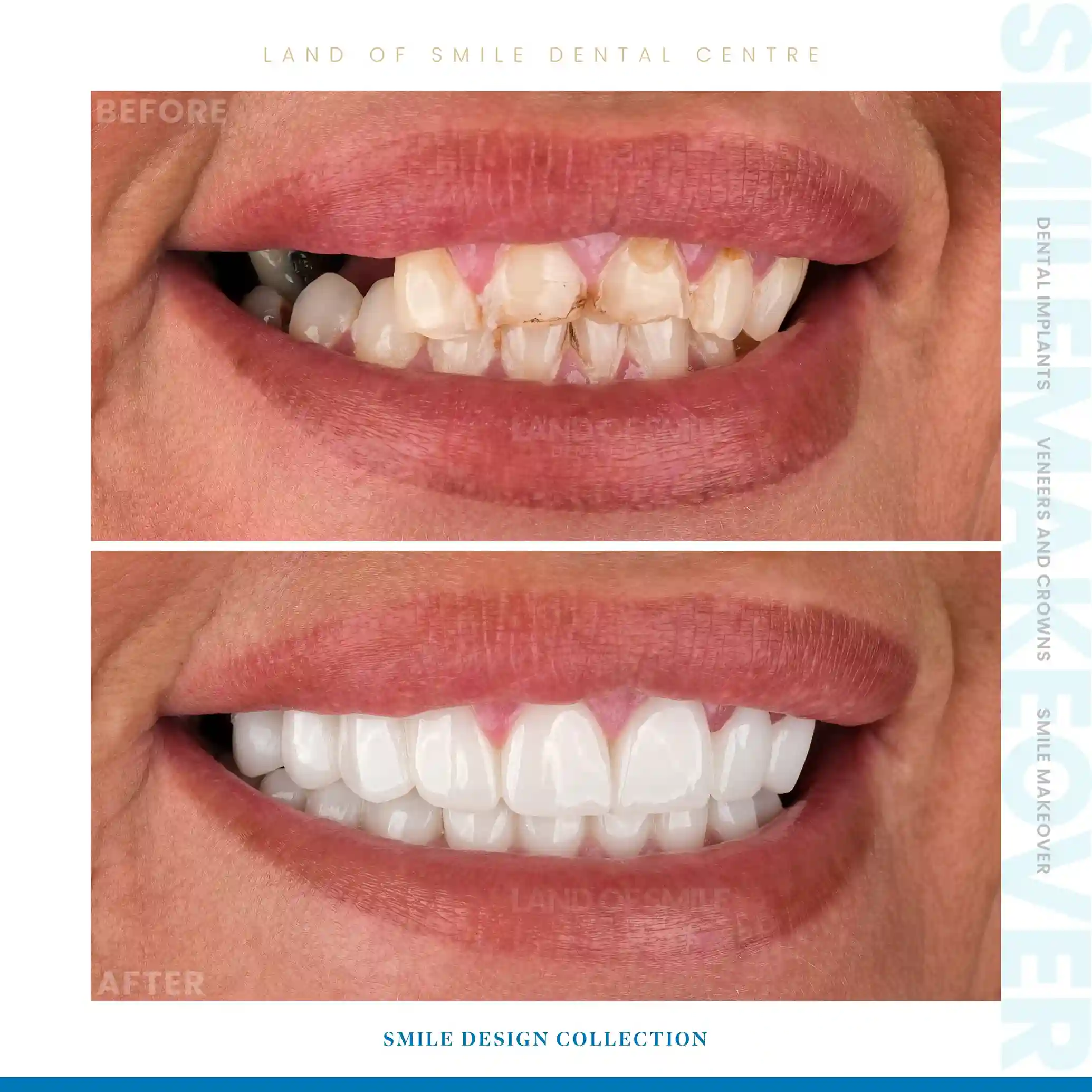 hollywood smile turkey
