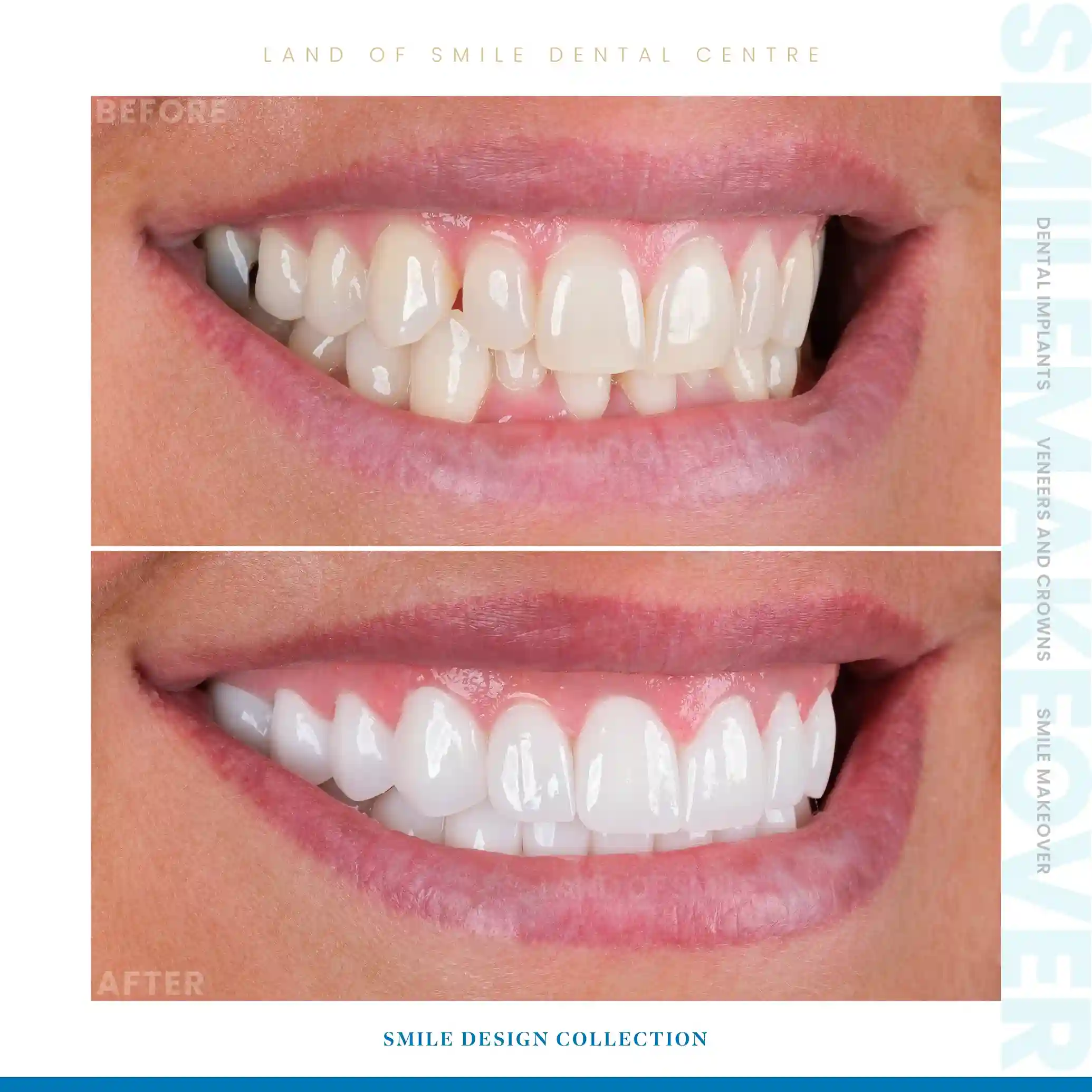 veneers
