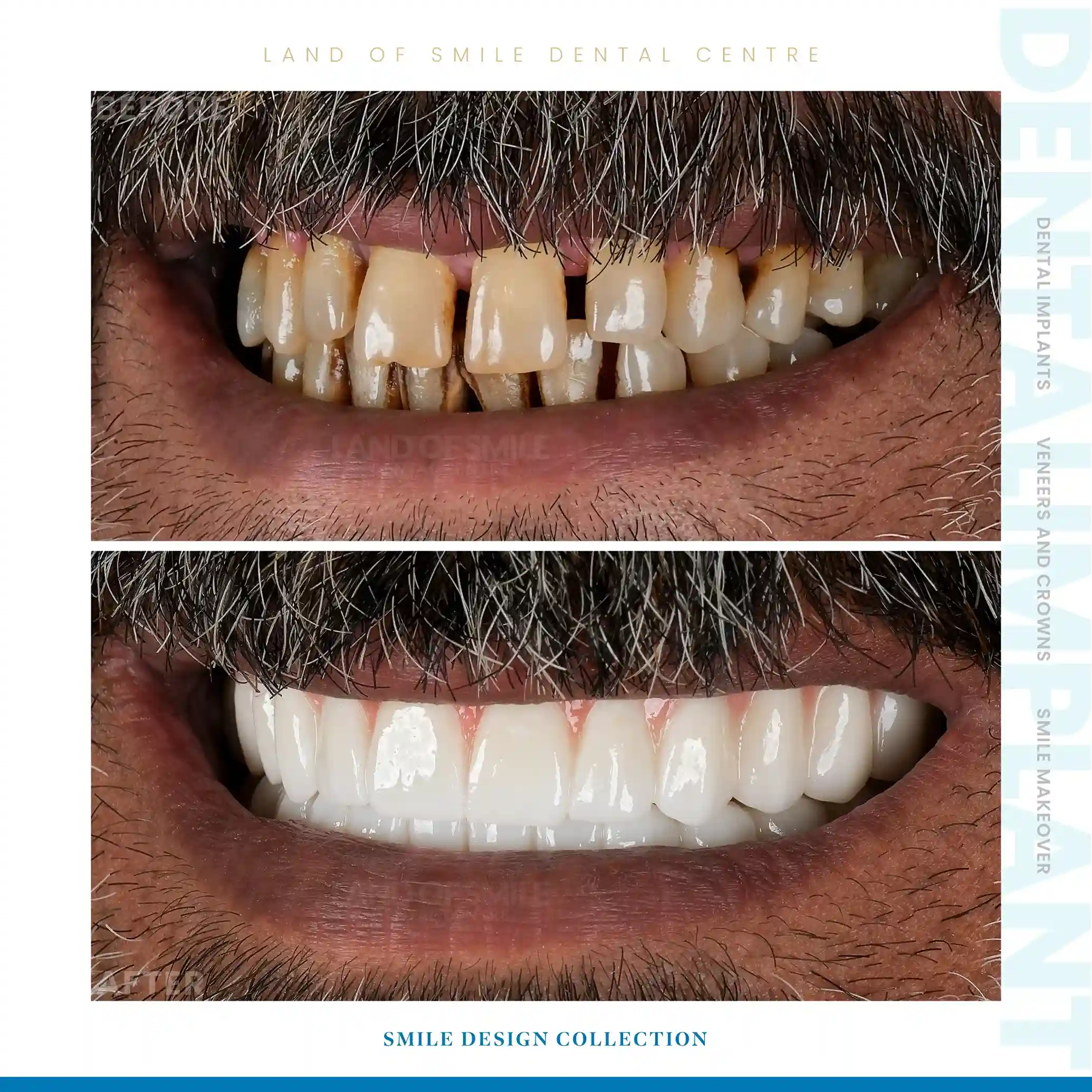 veneers