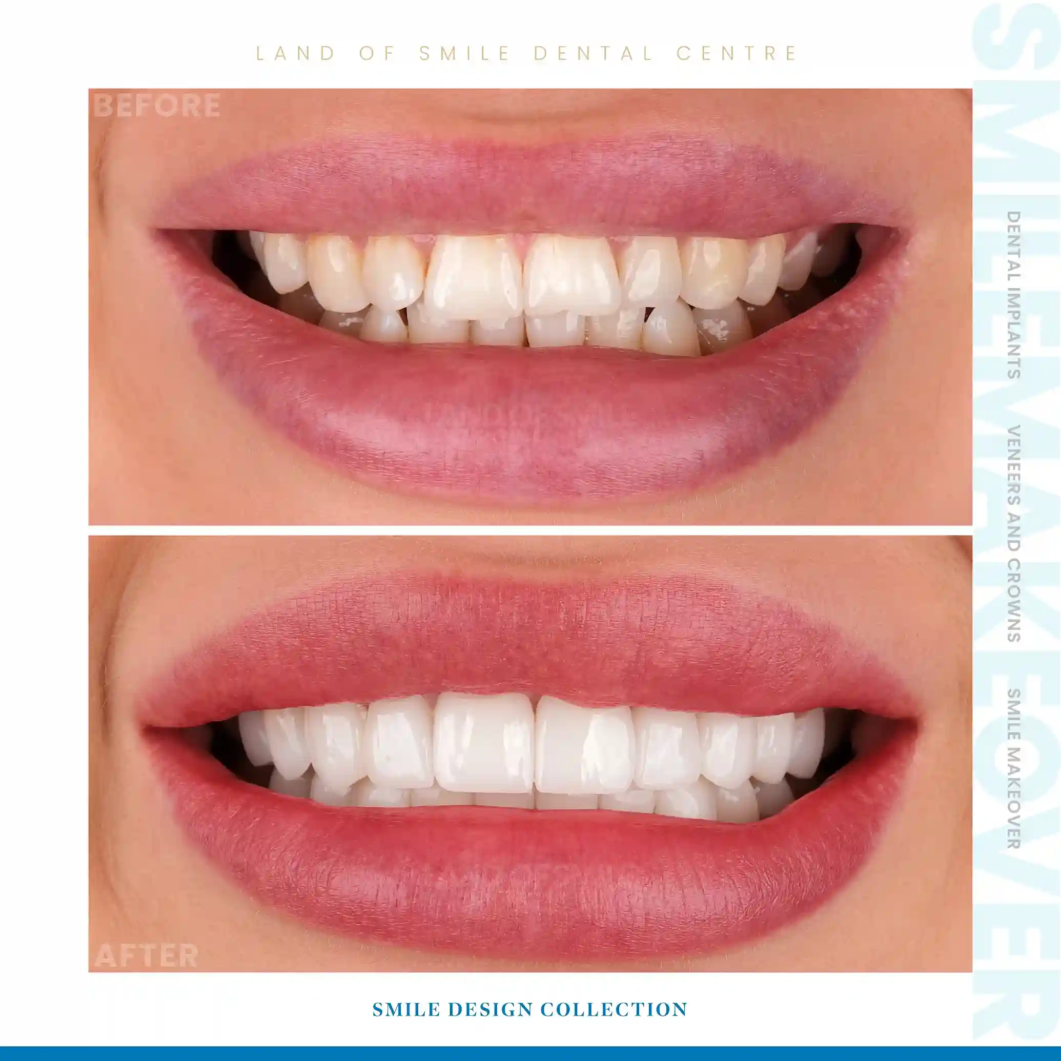 veneers