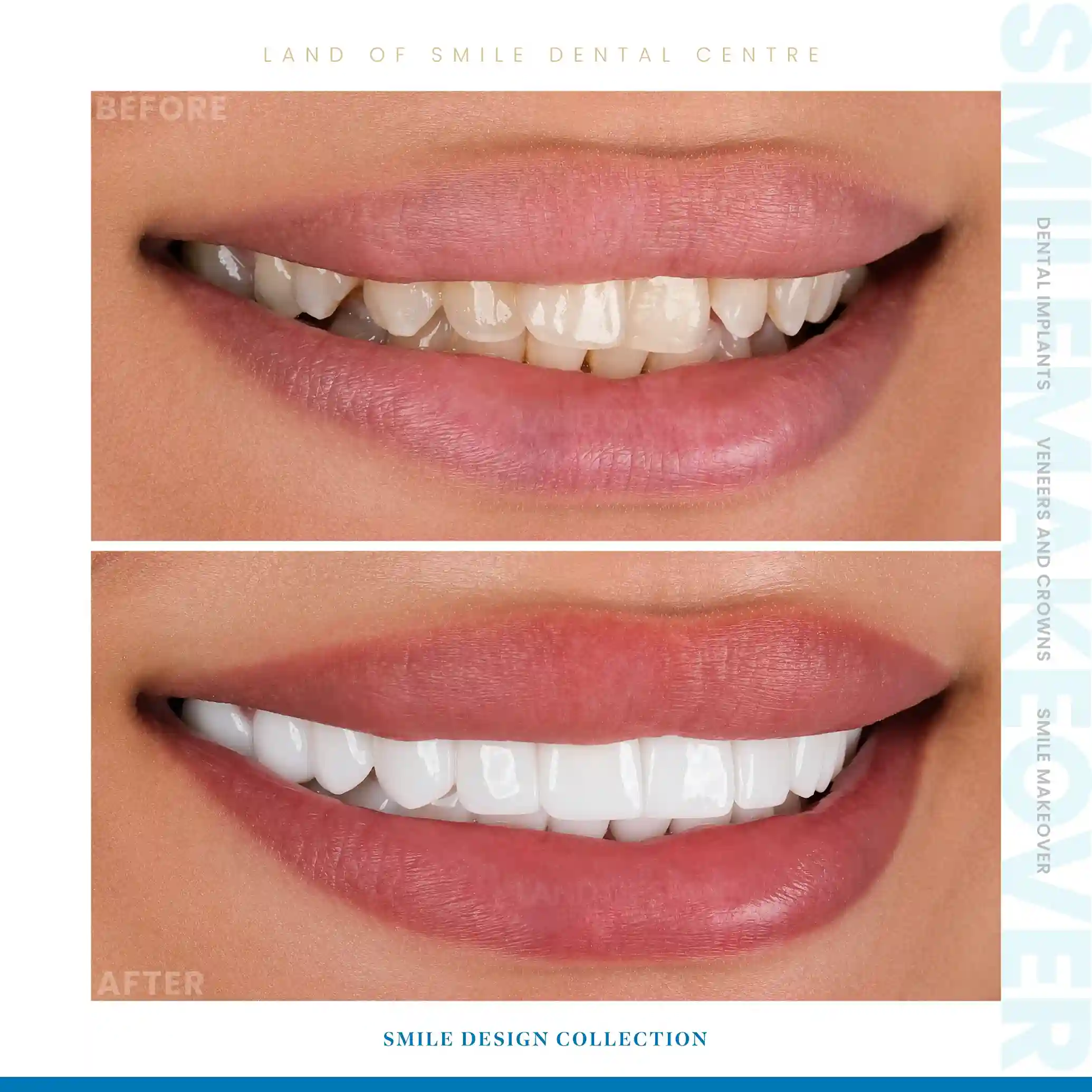 veneers