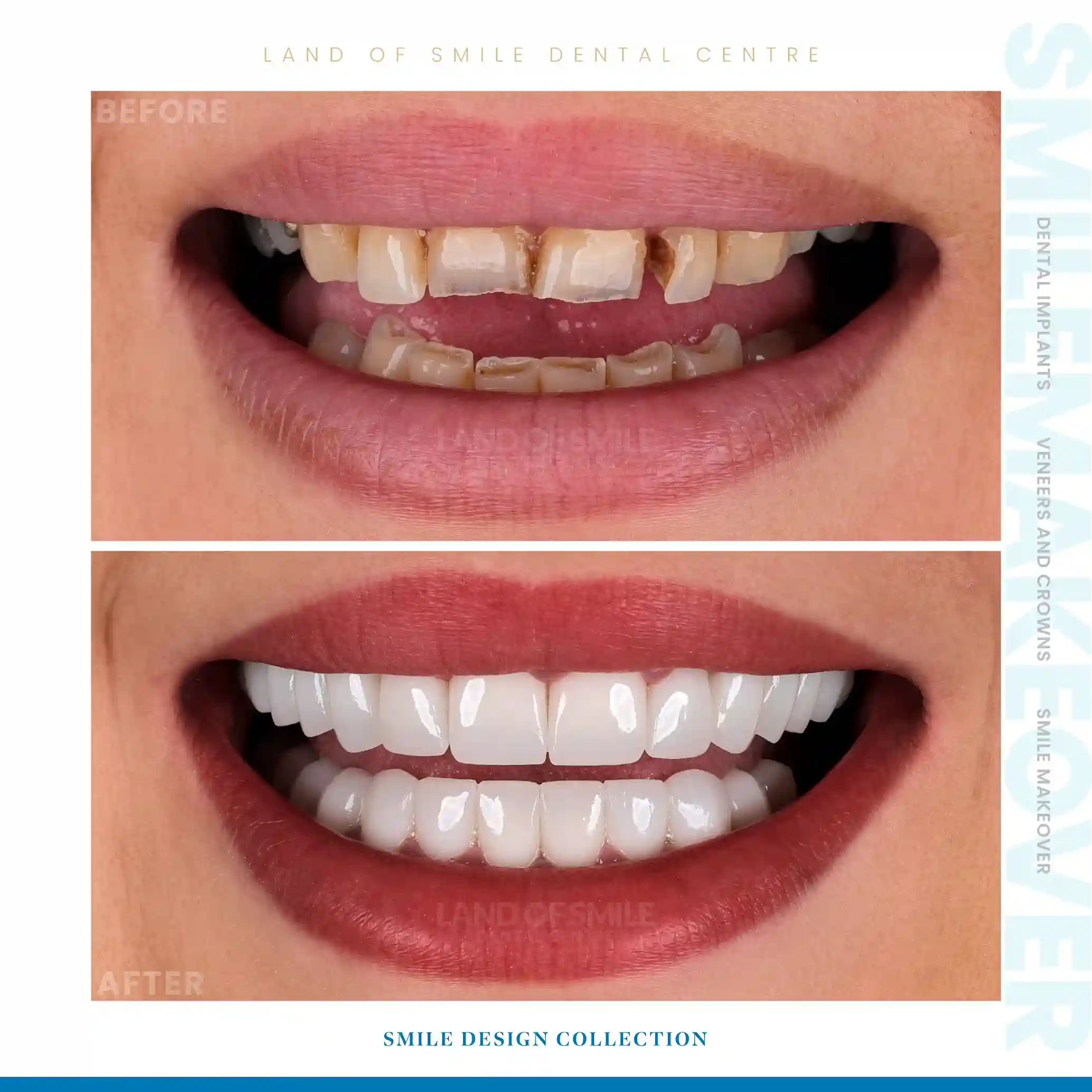 veneers