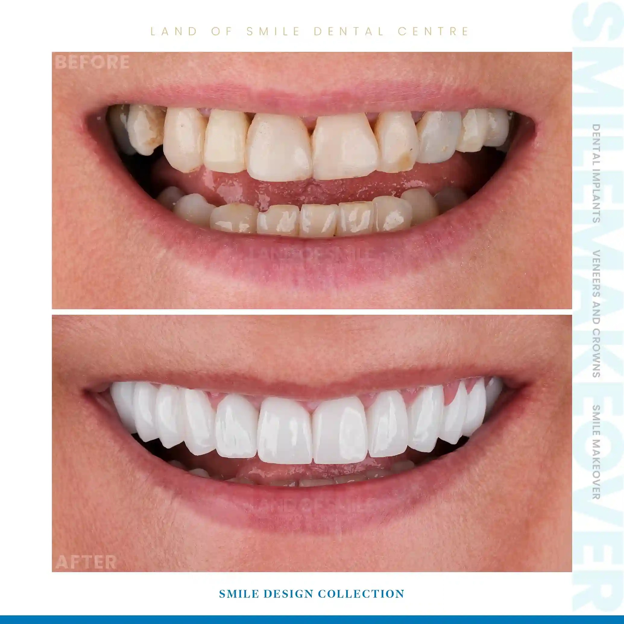 veneers