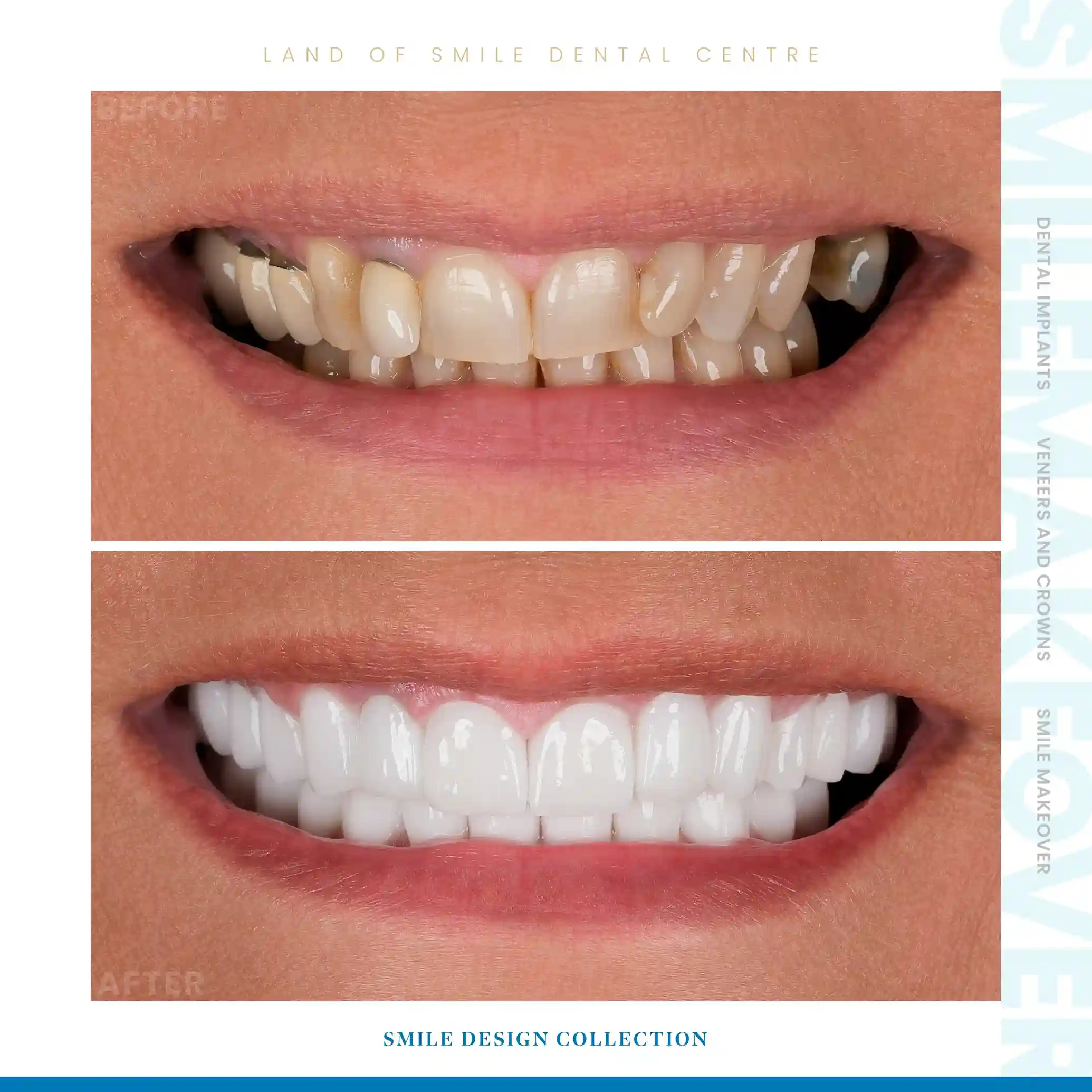 veneers