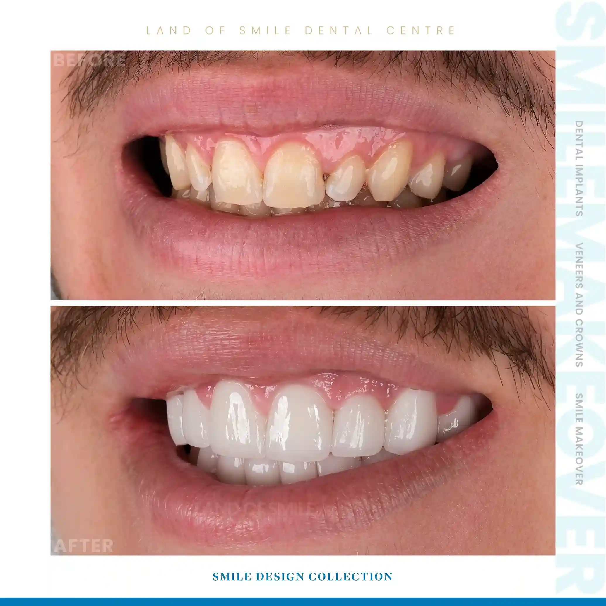 veneers
