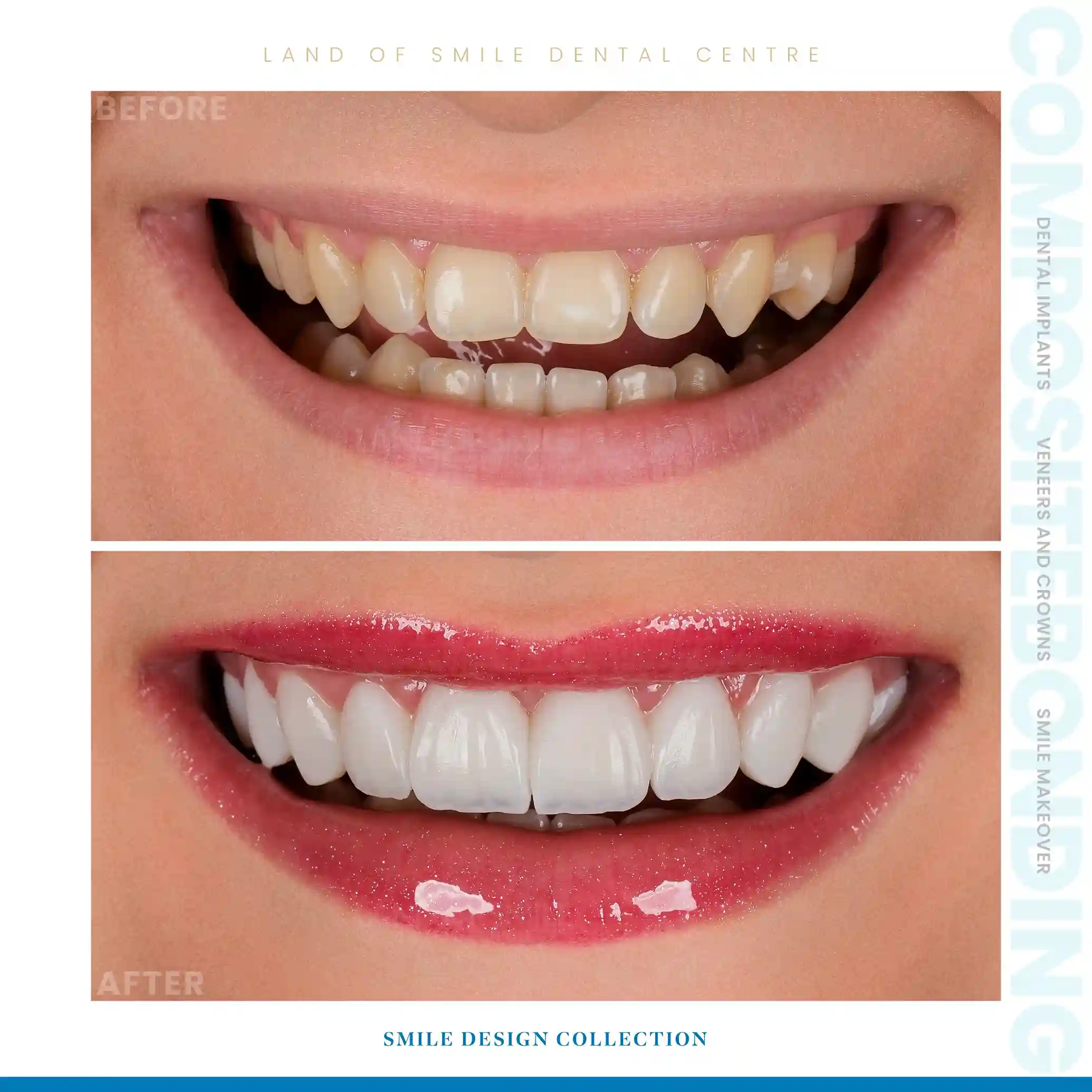 veneers